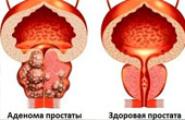 Что такое аденома простаты
