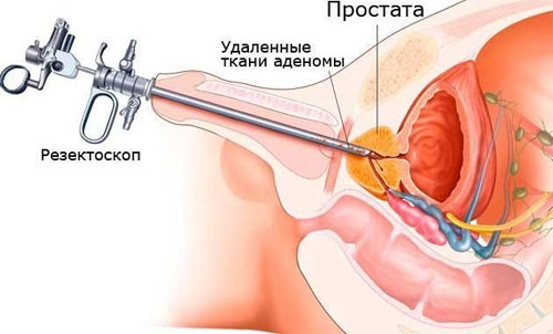 Что такое аденома простаты